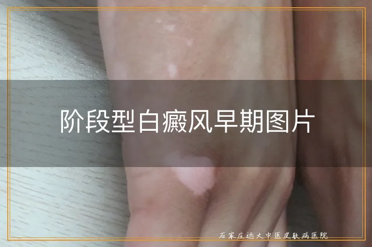 阶段型白癜风早期图片