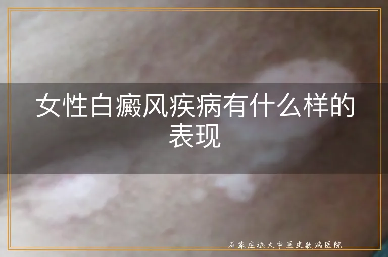 女性白癜风疾病有什么样的表现