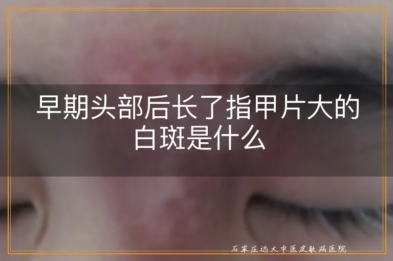 早期头部后长了指甲片大的白斑是什么