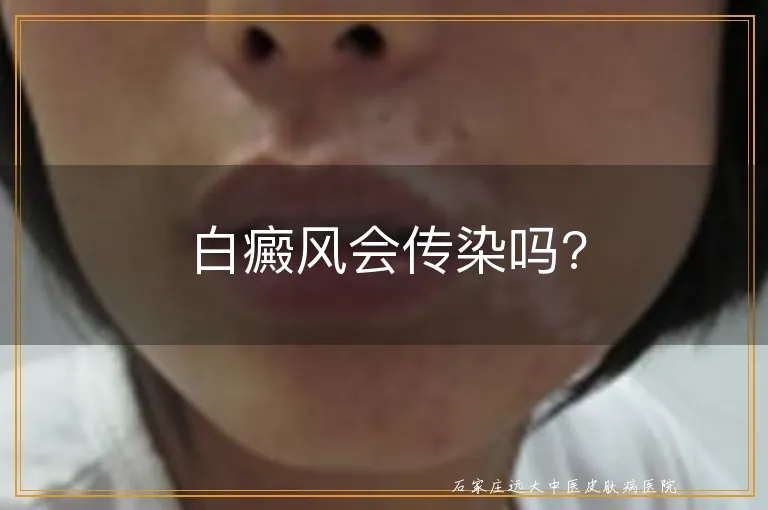 白癜风会传染吗?