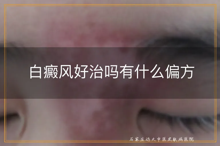 白癜风好治吗有什么偏方