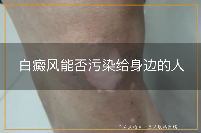 白癜风能否污染给身边的人