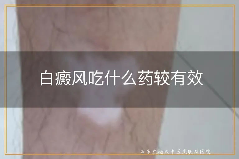 白癜风吃什么药较有效