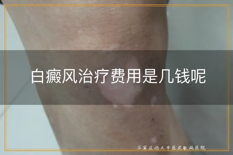 白癜风治疗费用是几钱呢