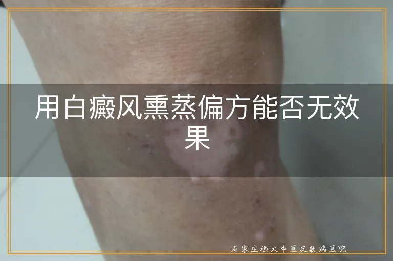 用白癜风熏蒸偏方能否无效果