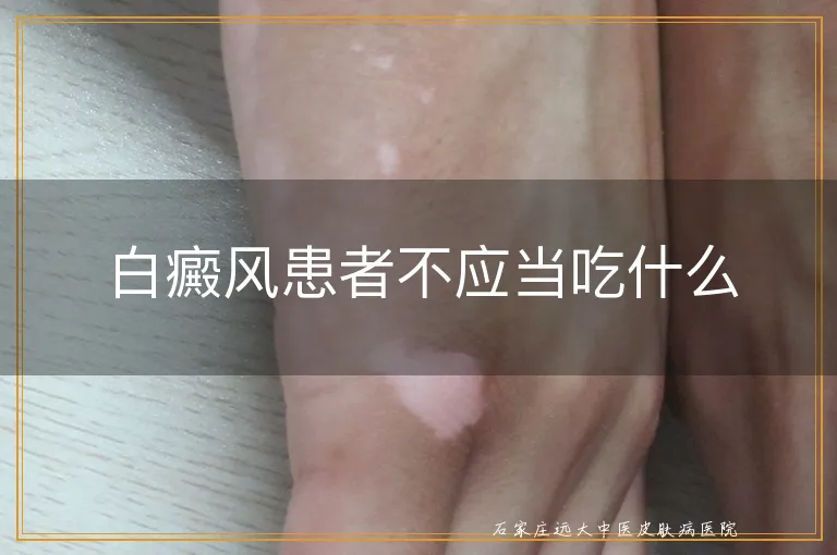 白癜风患者不应当吃什么