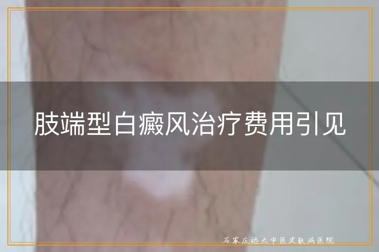 肢端型白癜风治疗费用引见