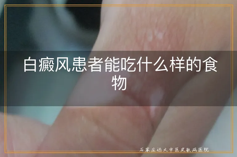 白癜风患者能吃什么样的食物