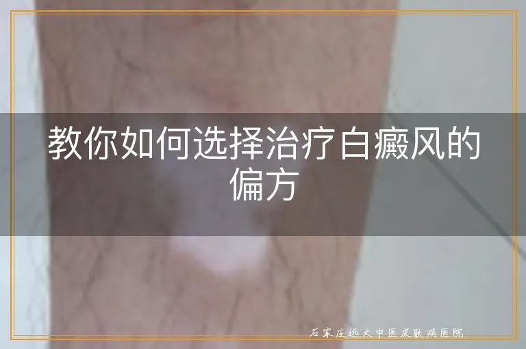 教你如何选择治疗白癜风的偏方