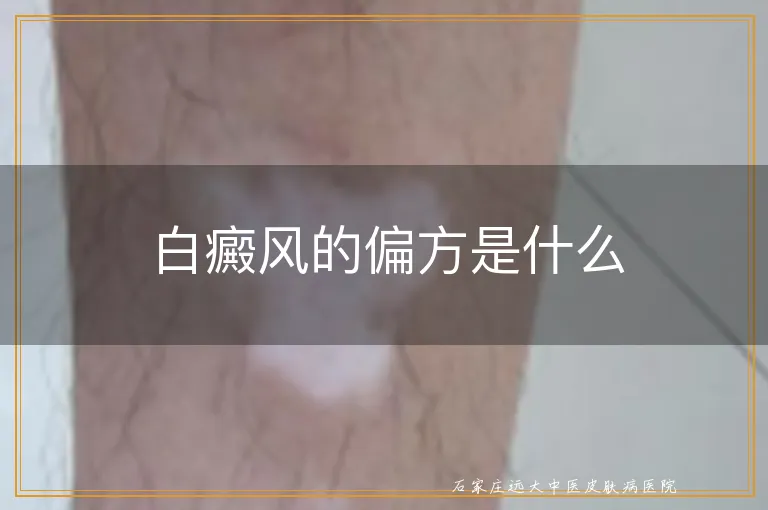 白癜风的偏方是什么