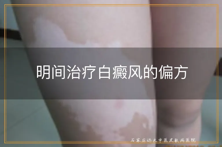 明间治疗白癜风的偏方