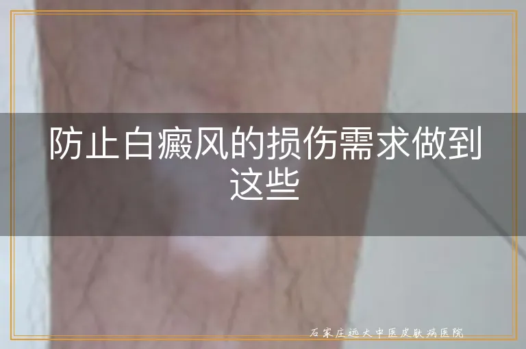 防止白癜风的损伤需求做到这些