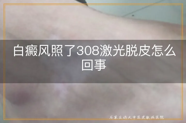 白癜风照了308激光脱皮怎么回事