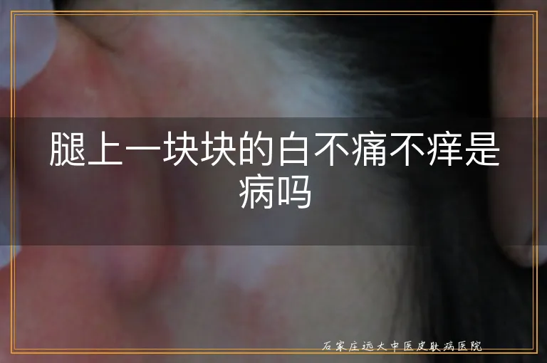 腿上一块块的白不痛不痒是病吗