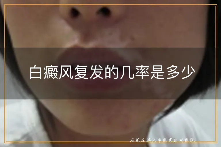 白癜风复发的几率是多少