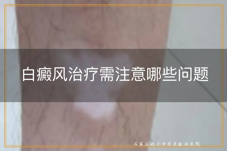 白癜风治疗需注意哪些问题