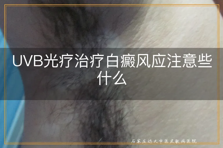 UVB光疗治疗白癜风应注意些什么