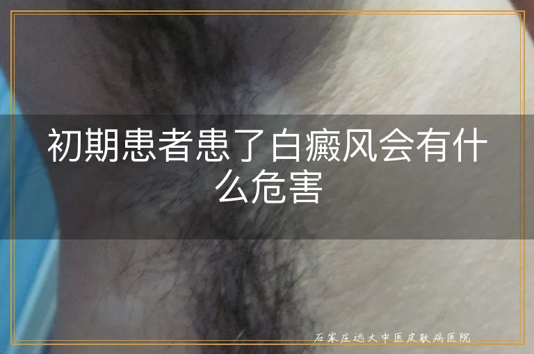 初期患者患了白癜风会有什么危害