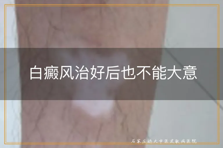 白癜风治好后也不能大意