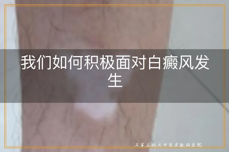 我们如何积极面对白癜风发生