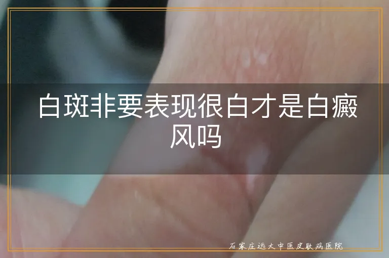 白斑非要表现很白才是白癜风吗