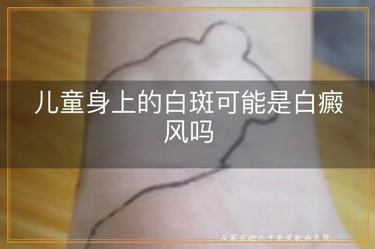 儿童身上的白斑可能是白癜风吗