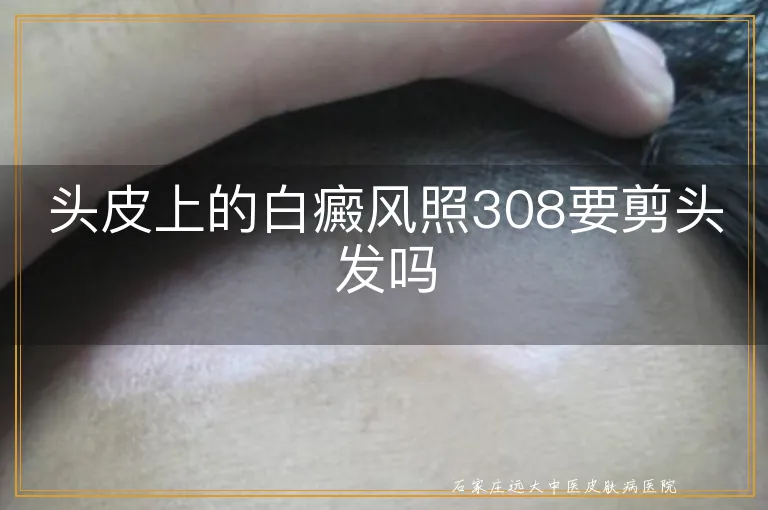 头皮上的白癜风照308要剪头发吗