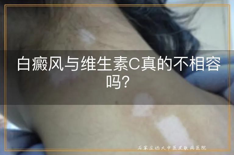 白癜风与维生素C真的不相容吗？