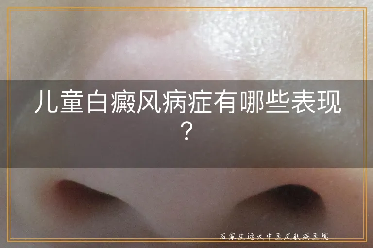 儿童白癜风病症有哪些表现？