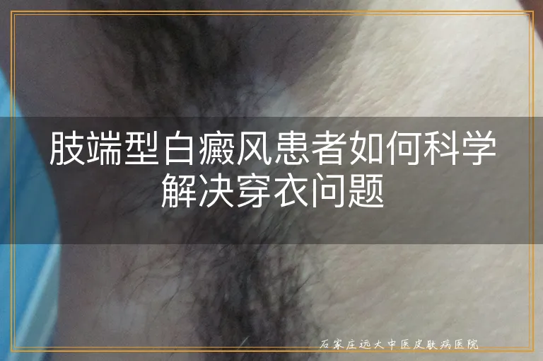 肢端型白癜风患者如何科学解决穿衣问题