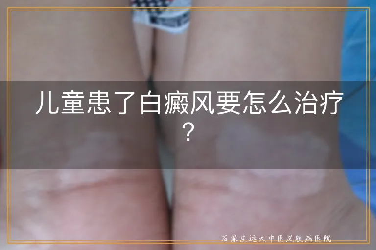 儿童患了白癜风要怎么治疗？