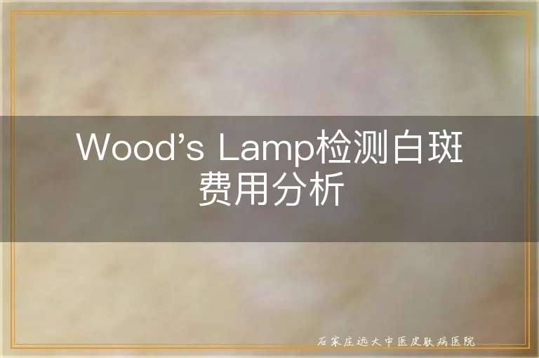 Wood's Lamp检测白斑费用分析