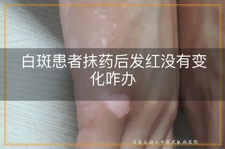 白斑患者抹药后发红没有变化咋办