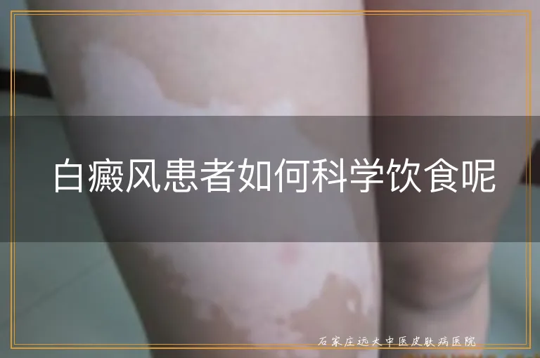 白癜风患者如何科学饮食呢