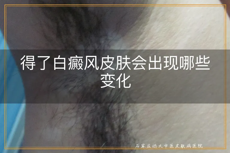 得了白癜风皮肤会出现哪些变化