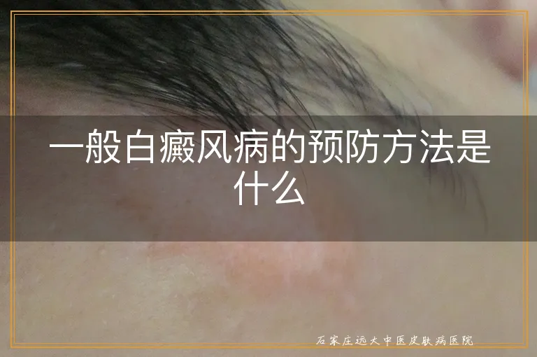 一般白癜风病的预防方法是什么