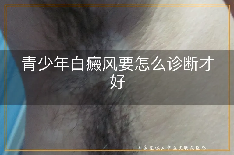 青少年白癜风要怎么诊断才好