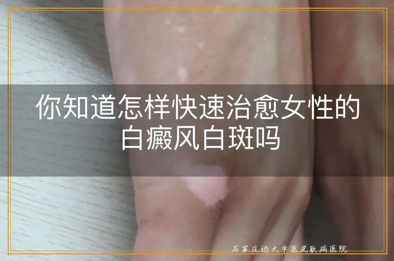 你知道怎样快速治愈女性的白癜风白斑吗