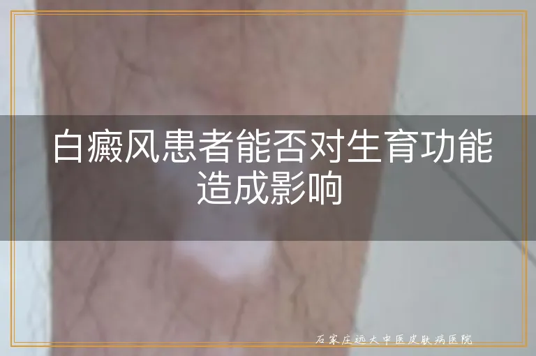 白癜风患者能否对生育功能造成影响