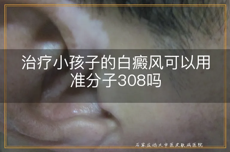 治疗小孩子的白癜风可以用准分子308吗