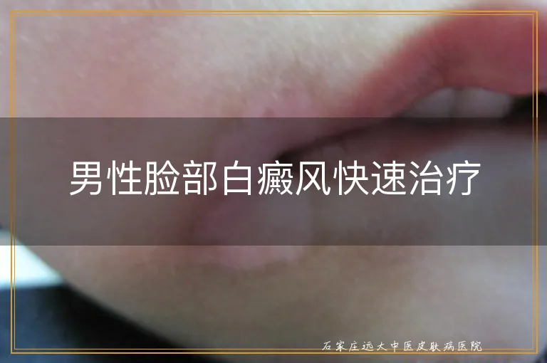 男性脸部白癜风快速治疗