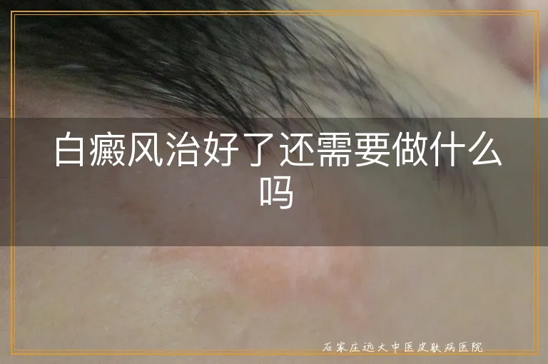 白癜风治好了还需要做什么吗