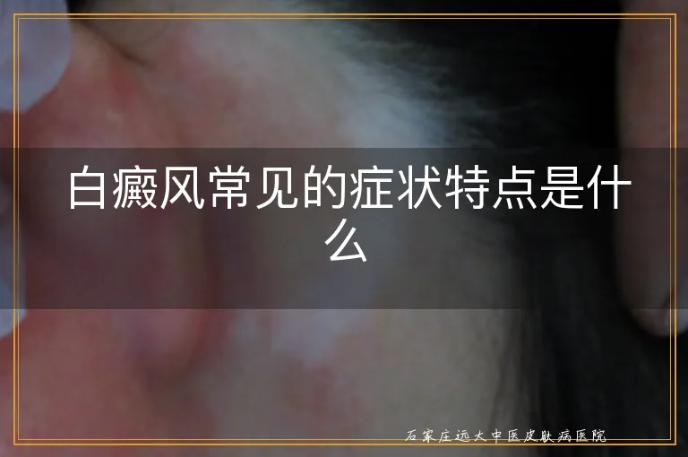 白癜风常见的症状特点是什么