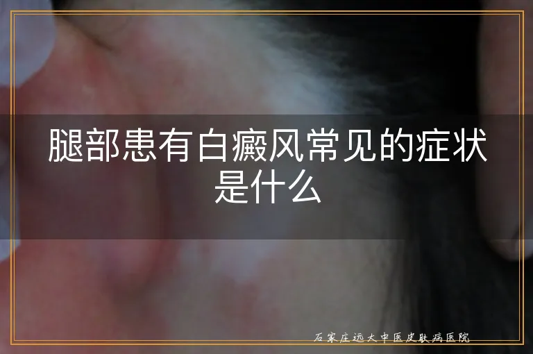 腿部患有白癜风常见的症状是什么