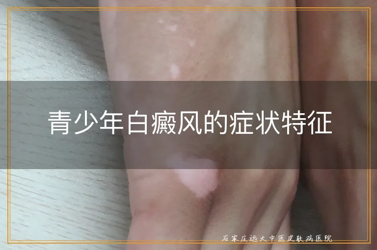 青少年白癜风的症状特征