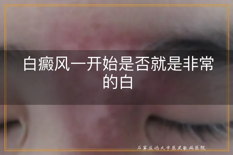 白癜风一开始是否就是非常的白