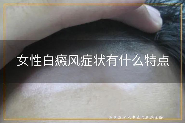 女性白癜风症状有什么特点