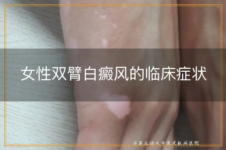 女性双臂白癜风的临床症状