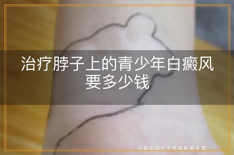 治疗脖子上的青少年白癜风要多少钱