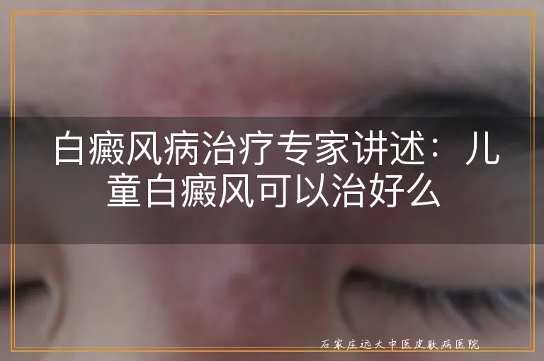 白癜风病治疗专家讲述：儿童白癜风可以治好么